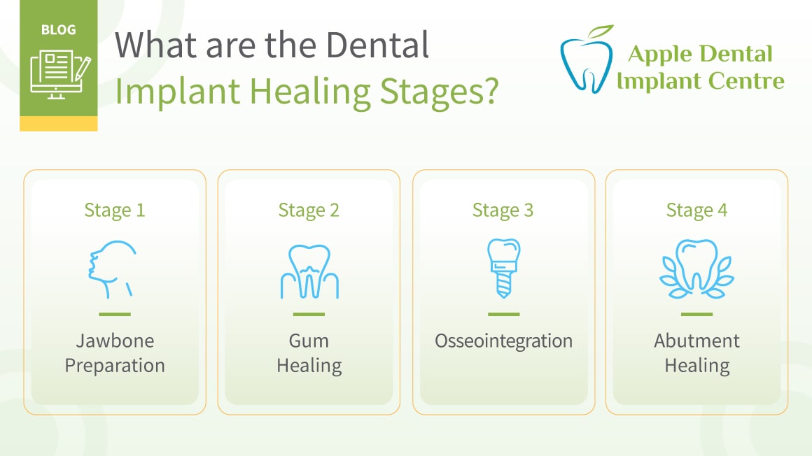 Dental Implant Healing Stages Everything You Need to Know
