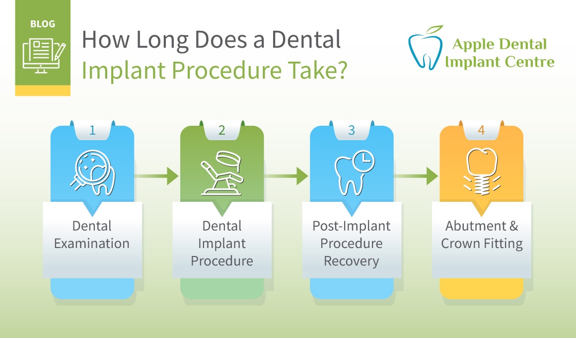 How Long Does a Dental Implant Procedure Take? Explained By Experts